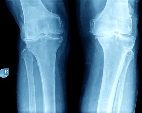 Knee Replacement