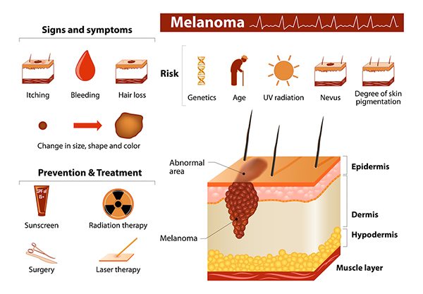 cancerous moles