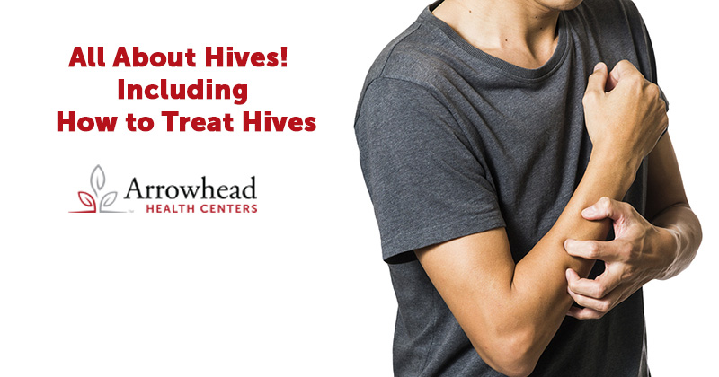 How to Treat Hives
