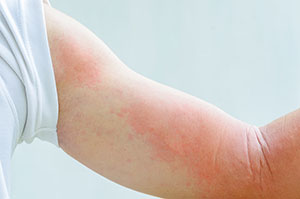 How to Treat Hives